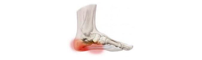 Plantar Fasciitis – What is it and Finding Relief