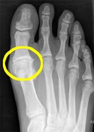 XRay of joint compression of the big toe causing arthritis and pain.